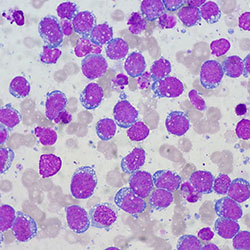 Phenotyping analysis of resected surgical tissue under the microscope. Purple stains express the presence of particular antigens at the cellular level.